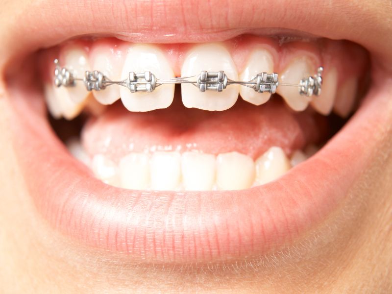 braces Perth