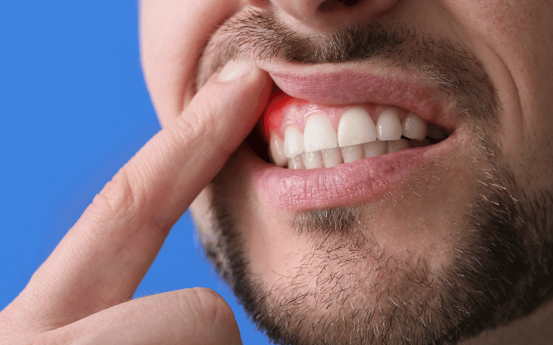 Gum disease