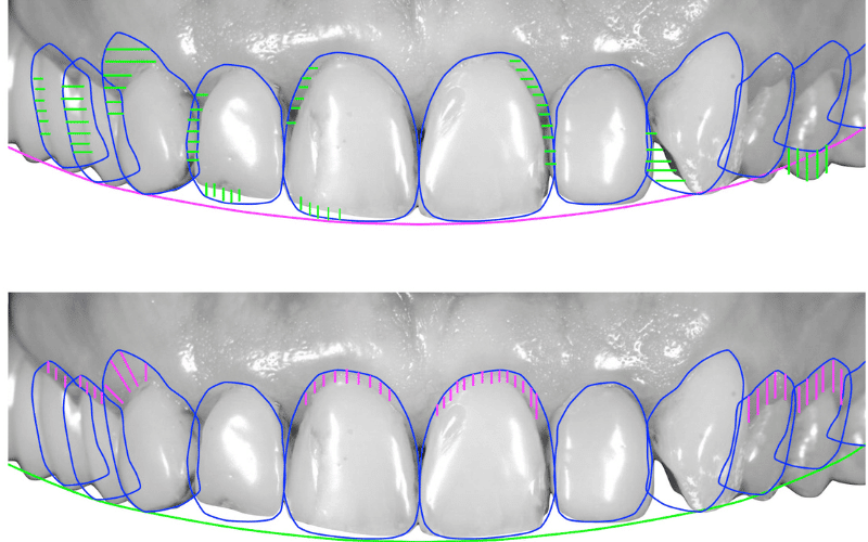 smile makeover procedure