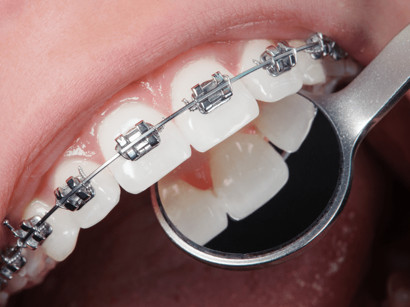 Orthodontics - dental clips